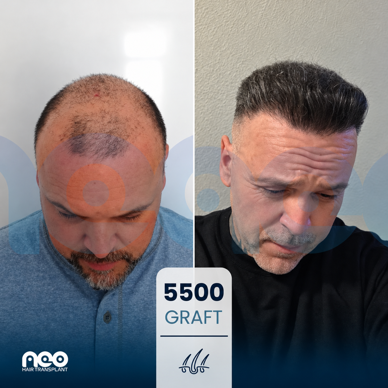 5500-graft hair transplant before and after at NEO