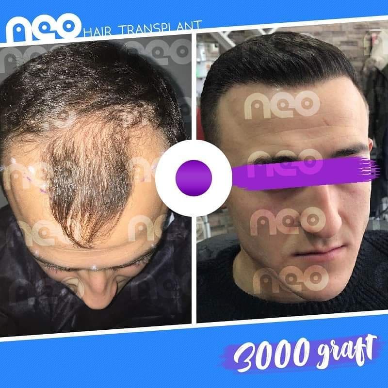 Hair-Transplant-turkey-neo-before-after-1