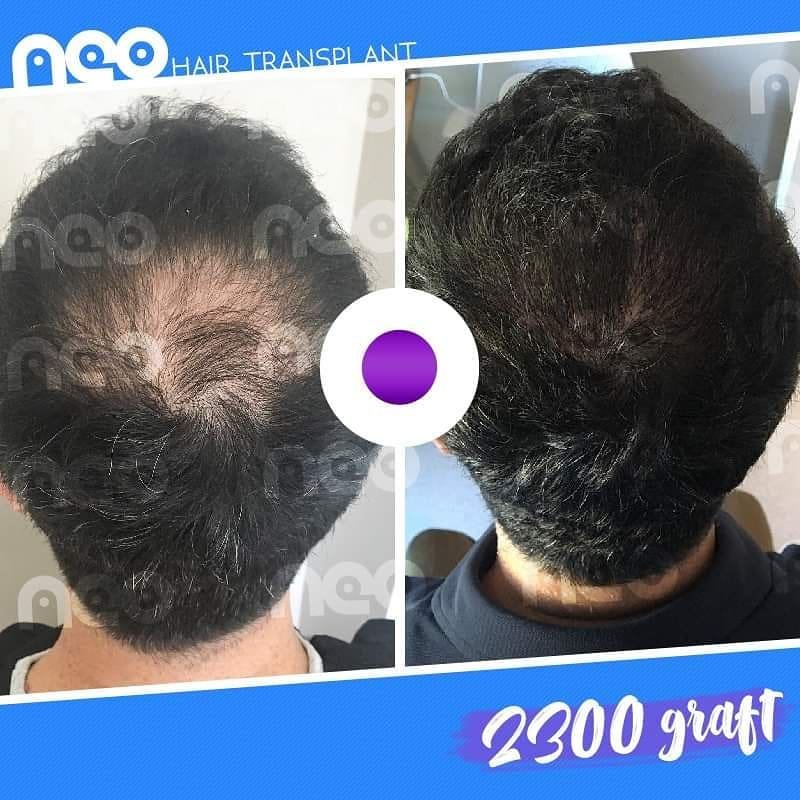 hair-transplant-turkey-neo-before-after-4