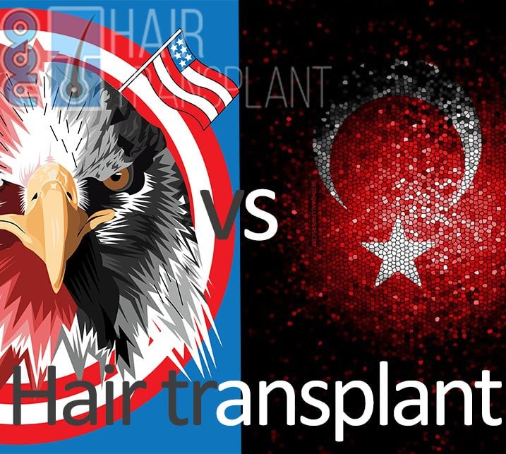 Hair Transplant Turkey vs Us (United States)