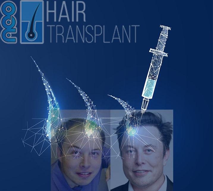 celebrities-hair-transplant
