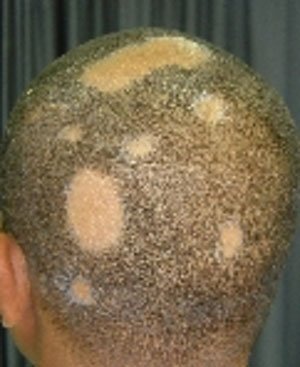 ringworm alopecia areata uZlnzakA |