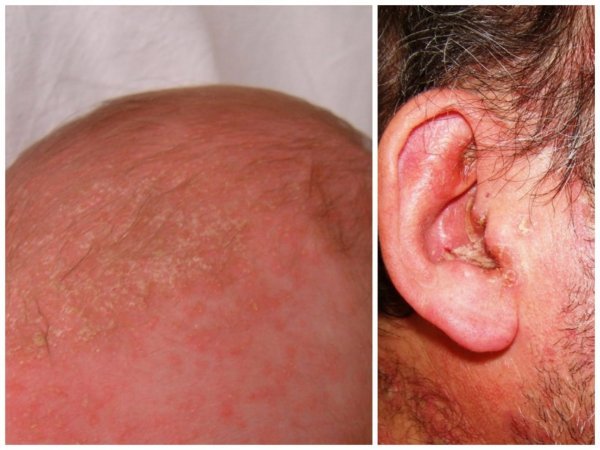 seborrheic dermatitis oily eczema host eJN23dk6 |