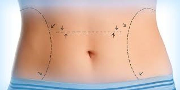 tummy tuck surgeries 2 tummy tuck surgeries pIFbu68H |