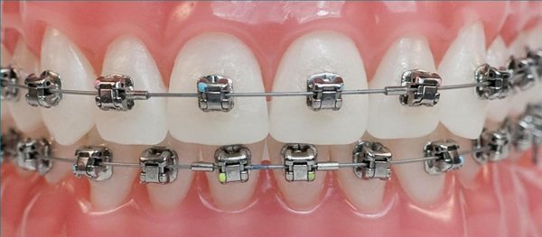 what awaits you when you start orthodontic treatment 3futihPS |