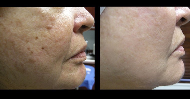 what is prp platelet rich plasma what are the benefits where is it used how long is it effective |