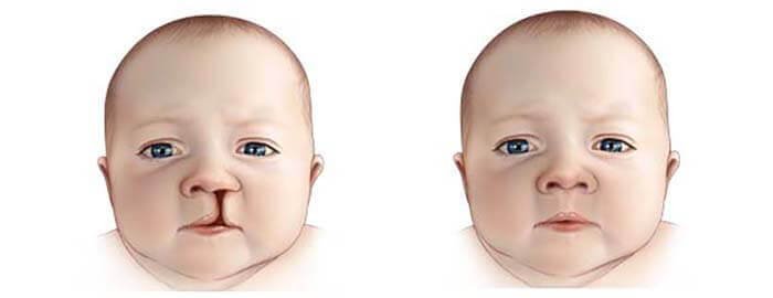 cleft lip and palate tHKPbRlQ |