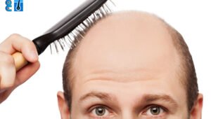Which Vitamin Deficiencies Cause Hair Loss?