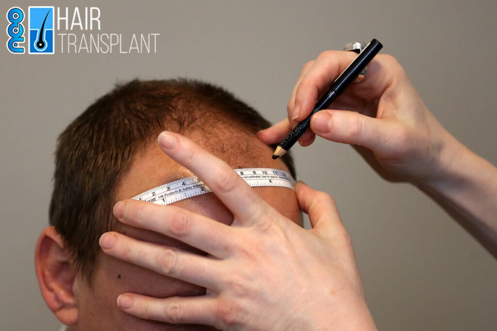 The Ultimate Guide to Hair Transplant Turkey: Everything You Need to Know