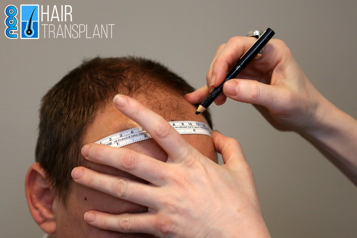 The Ultimate Guide to Hair Transplant Turkey: Everything You Need to Know