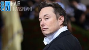 Elon Musk's Hair Transplant: All You Need to Know