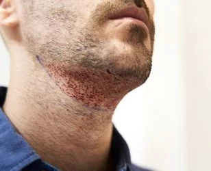 Beard Transplantation - Neohair Beard Transplant surgery photo01
