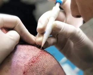 DHI Choi Hair Transplantation - Neohair DHI Choi Hair Transplantation - Neohair