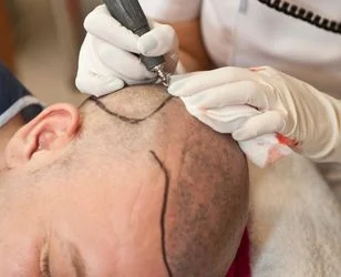 Percutaneous Hair Transplantation-neohair Neograft Hair Transplant surgery photo01