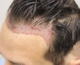 Unshaven Hair Fue Hair Transplant - Neohair Unshaven Hair Fue Hair Transplant - Neohair