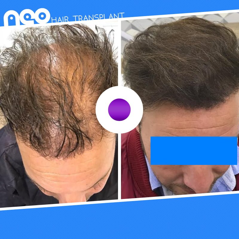 hair transplant before after