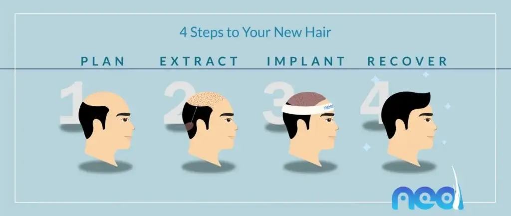 fue hair transplant turkey
