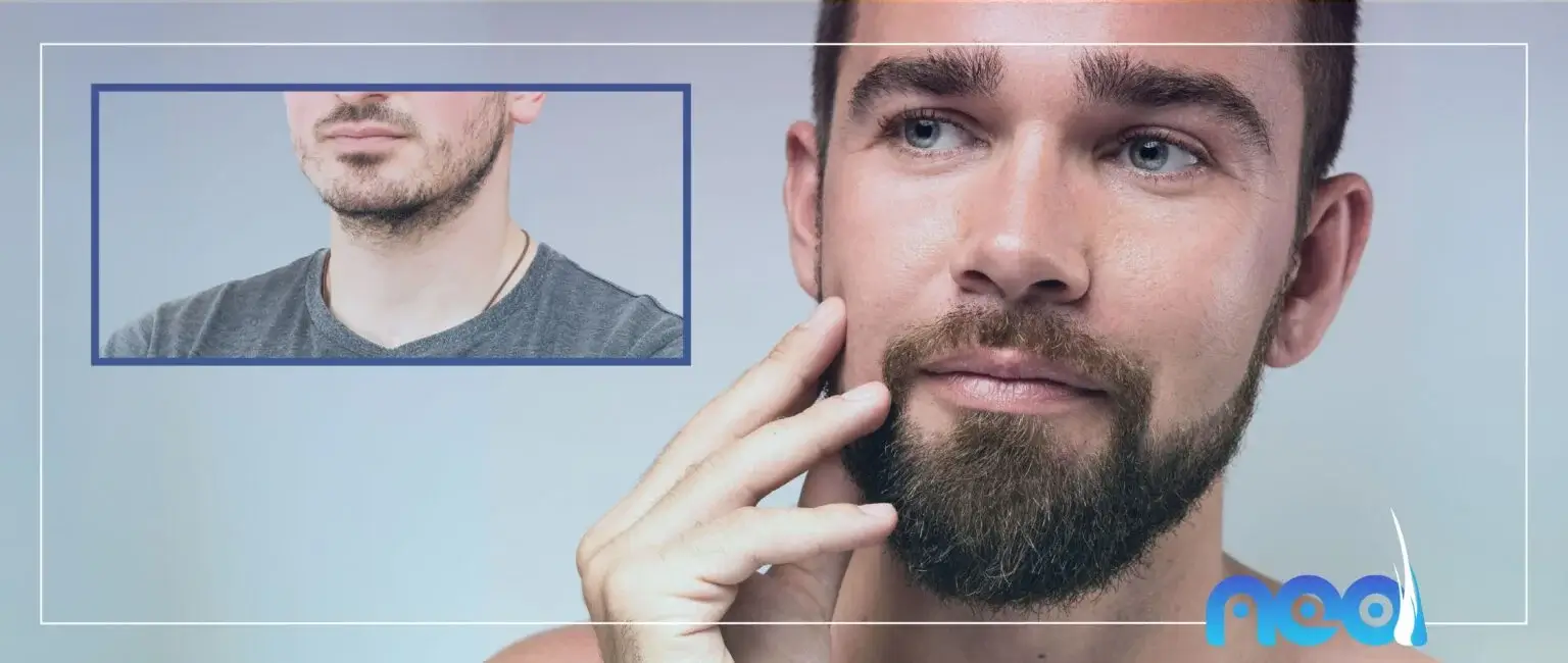 Beard transplant — NEO treatment guide