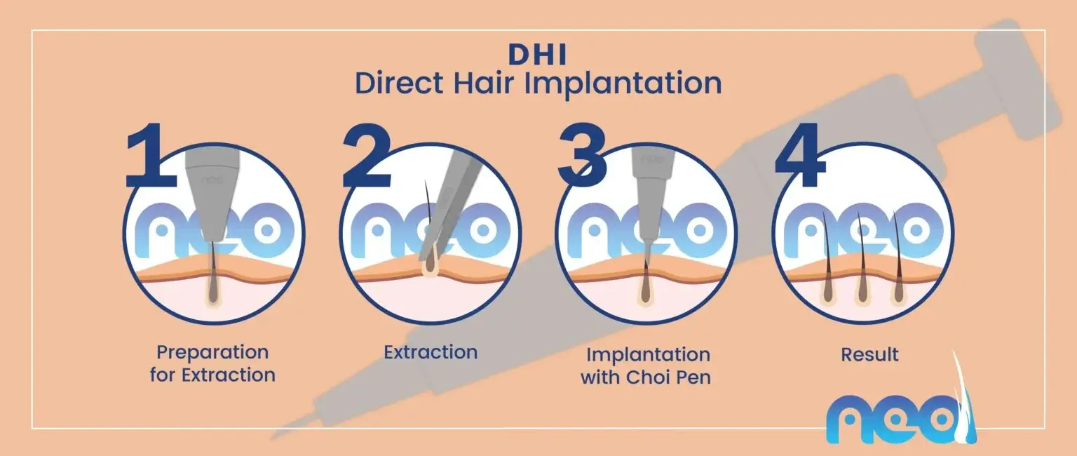 DHI hair transplant — NEO treatment guide