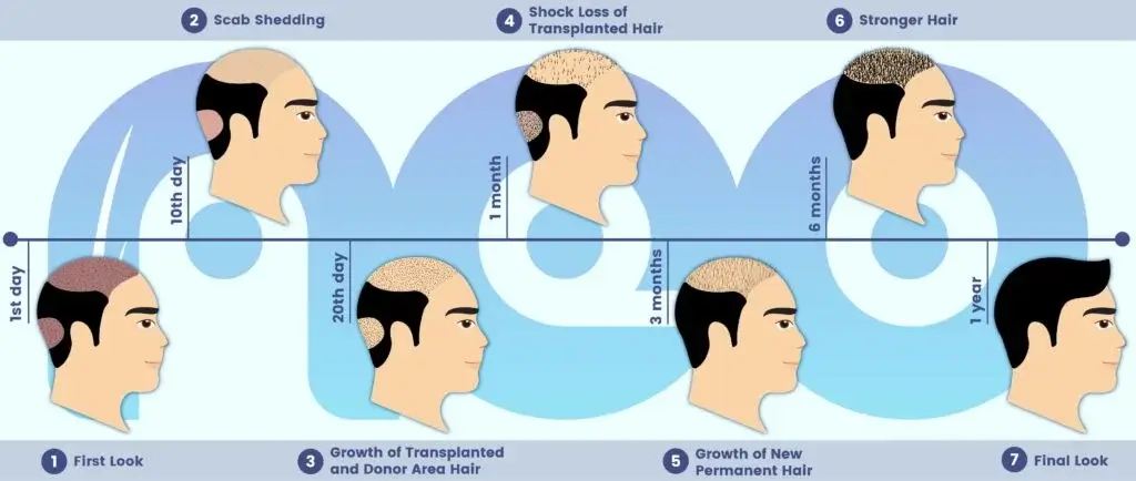 hair transplant clinic turkey