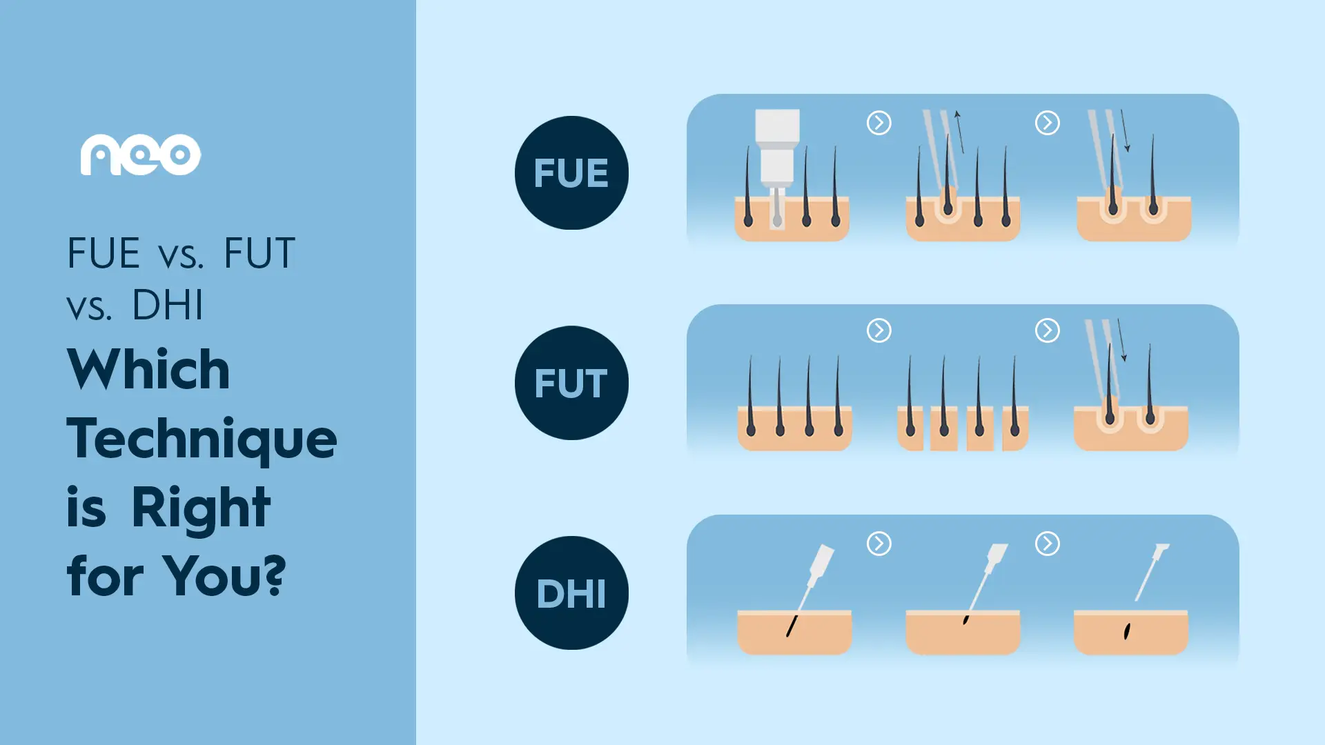 Hair Transplant Techniques at NEO Hair Transplant Istanbul