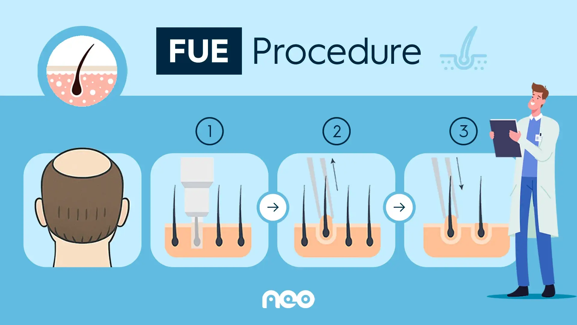 FUE hair transplant — NEO treatment guide