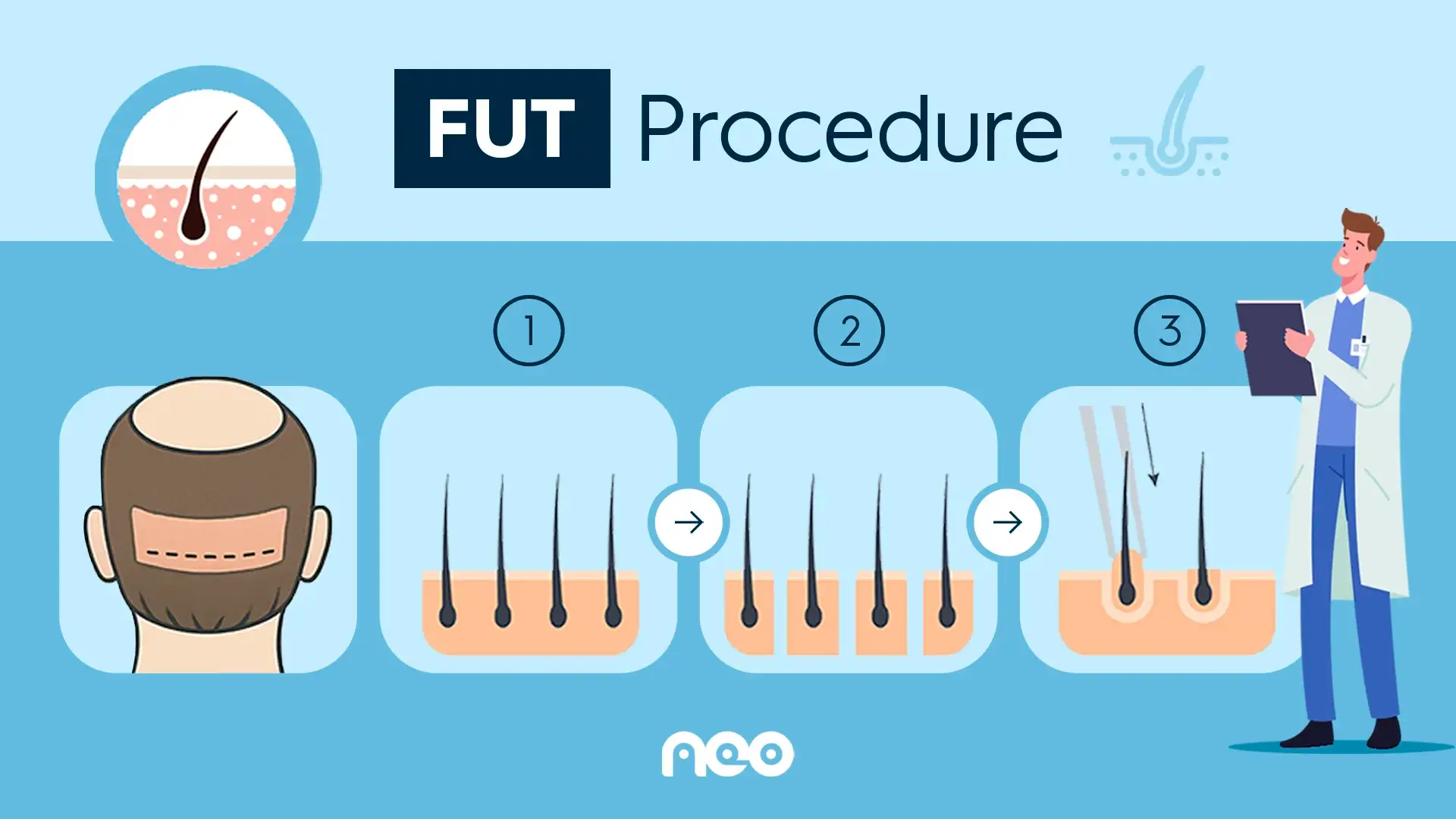 Hair Transplant Techniques at NEO Hair Transplant Istanbul