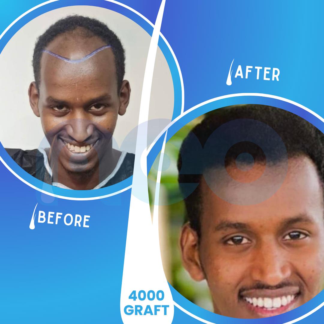 Hair transplant before and after results