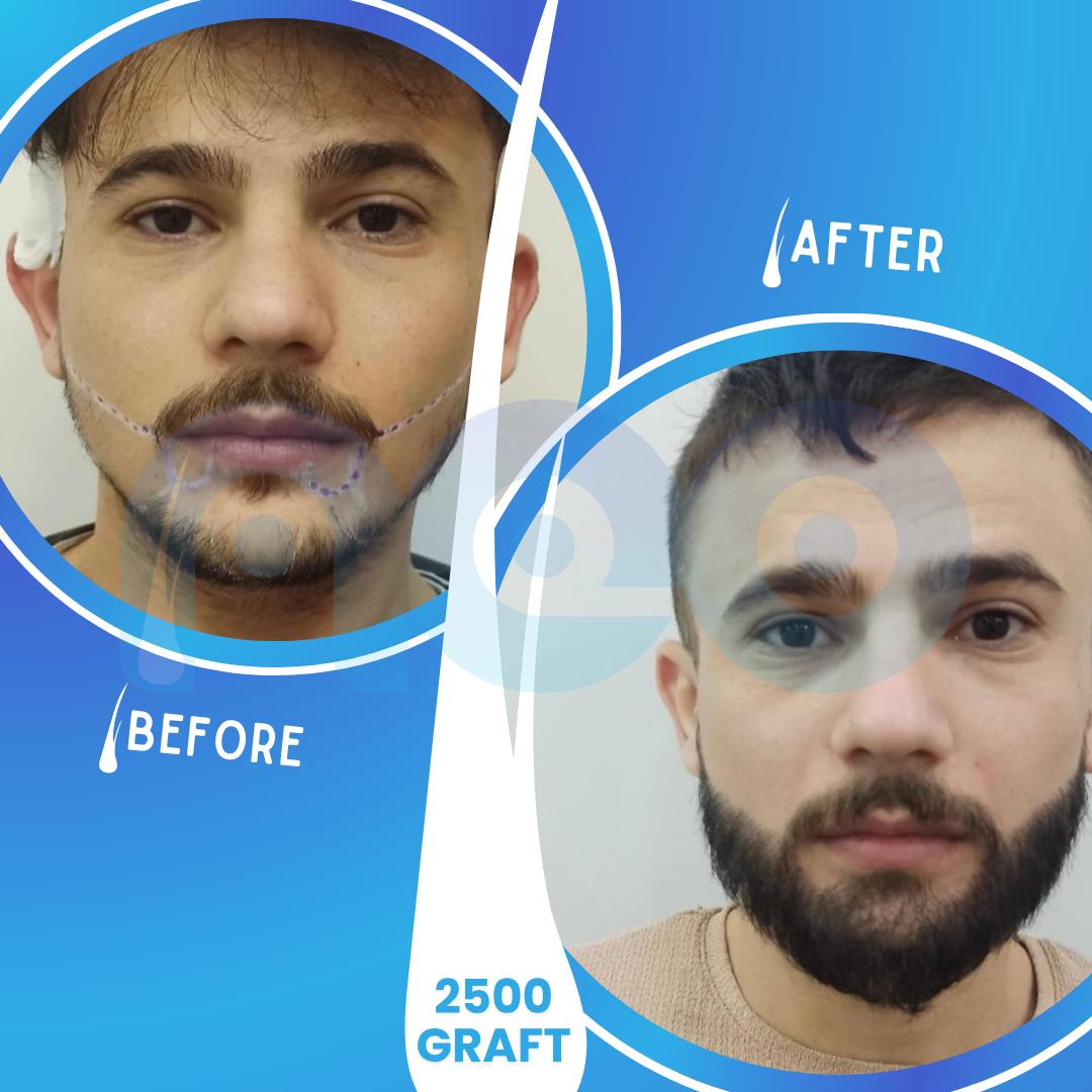 Hair transplant before and after results