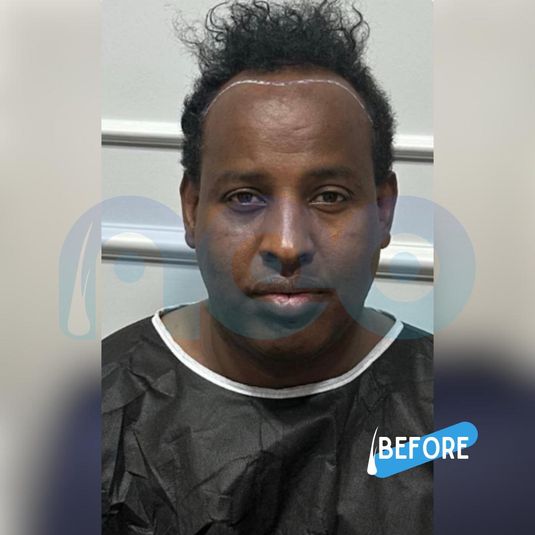 Afro Hair Transplant Before & After