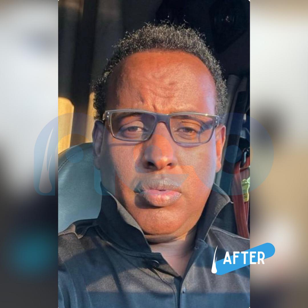 Afro Hair Transplant Before & After