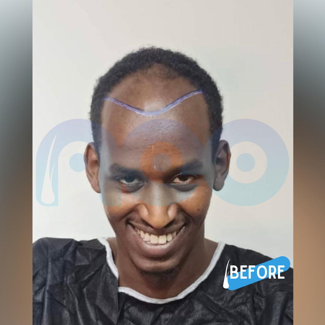 Afro hair transplant result at NEO Istanbul