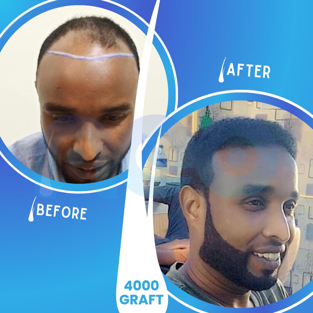 Hair transplant before and after results