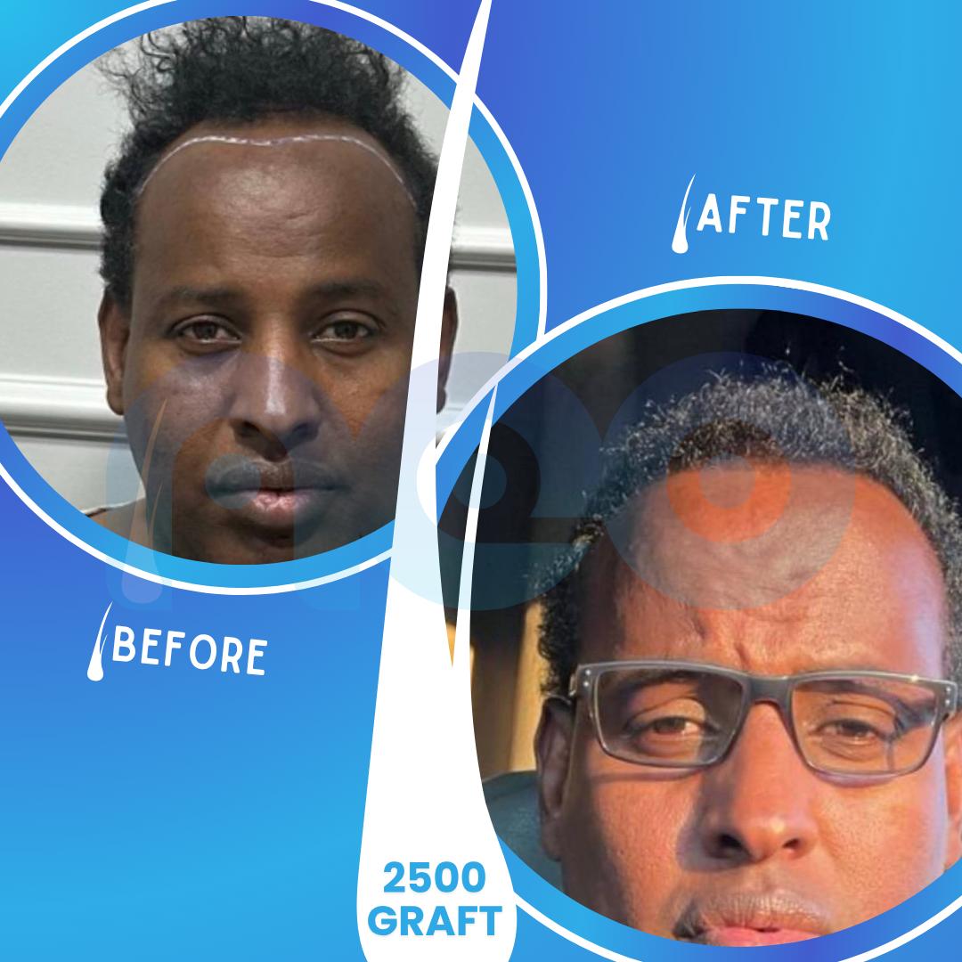 Hair transplant before and after results