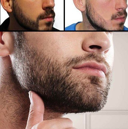 Beard Transplant in Turkey Before After Before and After of Beard Transplant Process